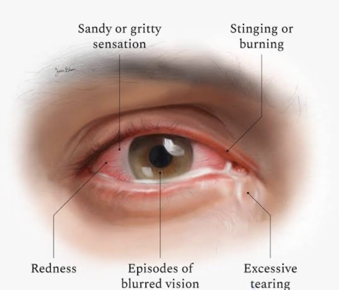 Intense dry eye therapy